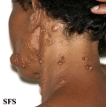 neurofibromatosis-segmental neurofibromatosis