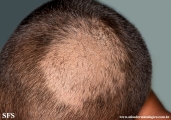 tinea capitis