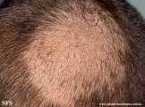 tinea capitis