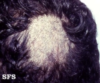 tinea capitis