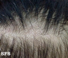 tinea capitis
