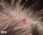 tinea capitis