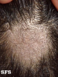 tinea capitis