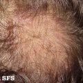tinea capitis