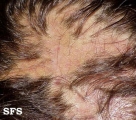 tinea capitis