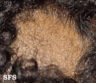 tinea capitis