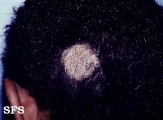 tinea capitis