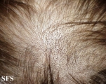 tinea capitis
