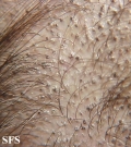 tinea capitis