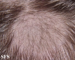tinea capitis