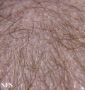 tinea capitis