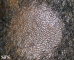 tinea capitis