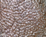 tinea capitis