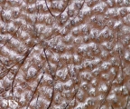 tinea capitis