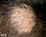 tinea capitis