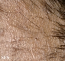 tinea capitis