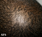 tinea capitis