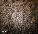 tinea capitis