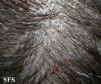 tinea capitis