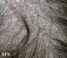 tinea capitis