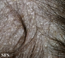 tinea capitis