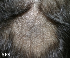 tinea capitis