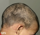 tinea capitis