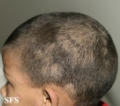 tinea capitis