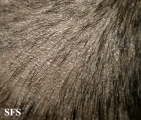 tinea capitis