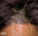 tinea capitis