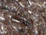 tinea capitis