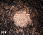 tinea capitis