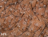 tinea capitis