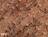 tinea capitis
