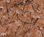 tinea capitis