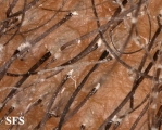tinea capitis