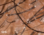 tinea capitis