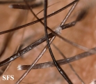 tinea capitis