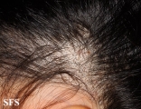 tinea capitis