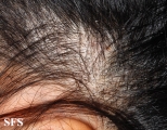 tinea capitis