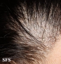tinea capitis
