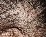 tinea capitis