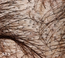 tinea capitis