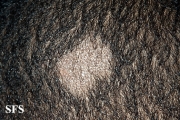 tinea capitis