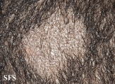 tinea capitis