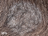 tinea capitis