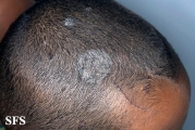 tinea capitis