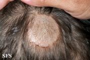 tinea capitis