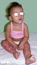 eczema herpeticum