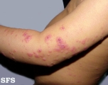 eczema herpeticum